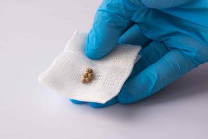gallstones treatment