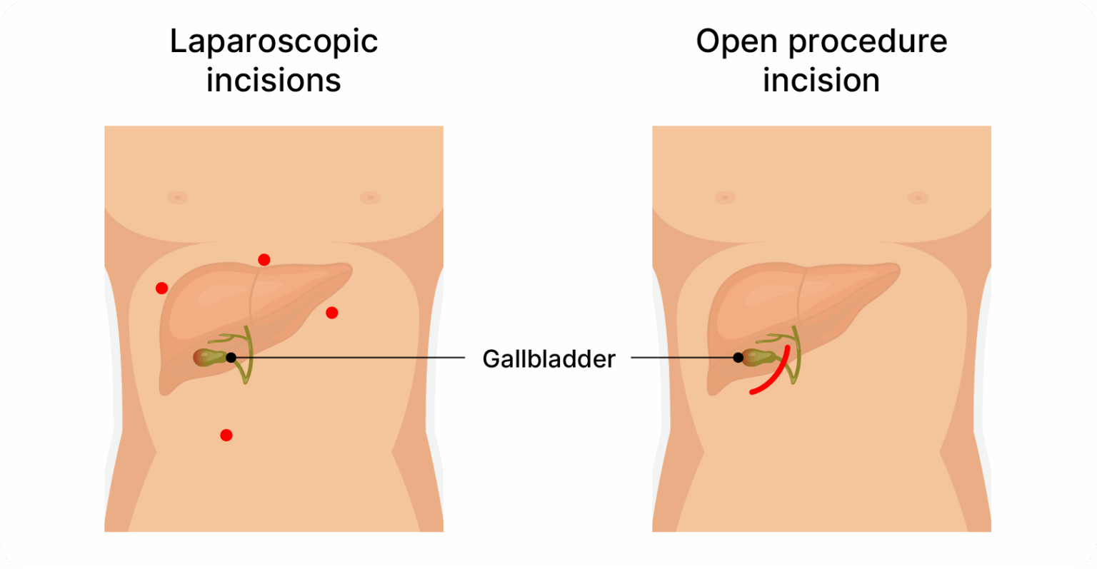 Gallbladder Removal | Aelius Surgical Centre