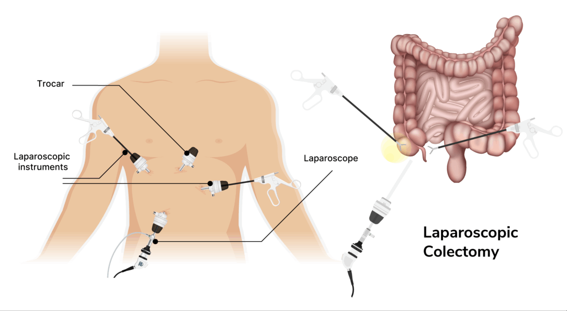 Post Colestopy Laparoscopic Colectomy | Aelius Surgical Centre