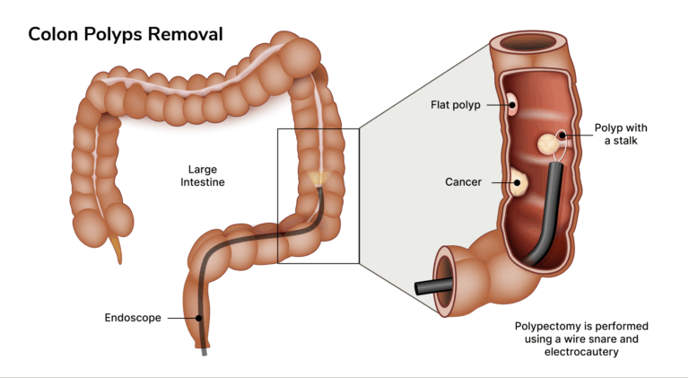 Colon Polypectomy | Aelius Surgical Centre