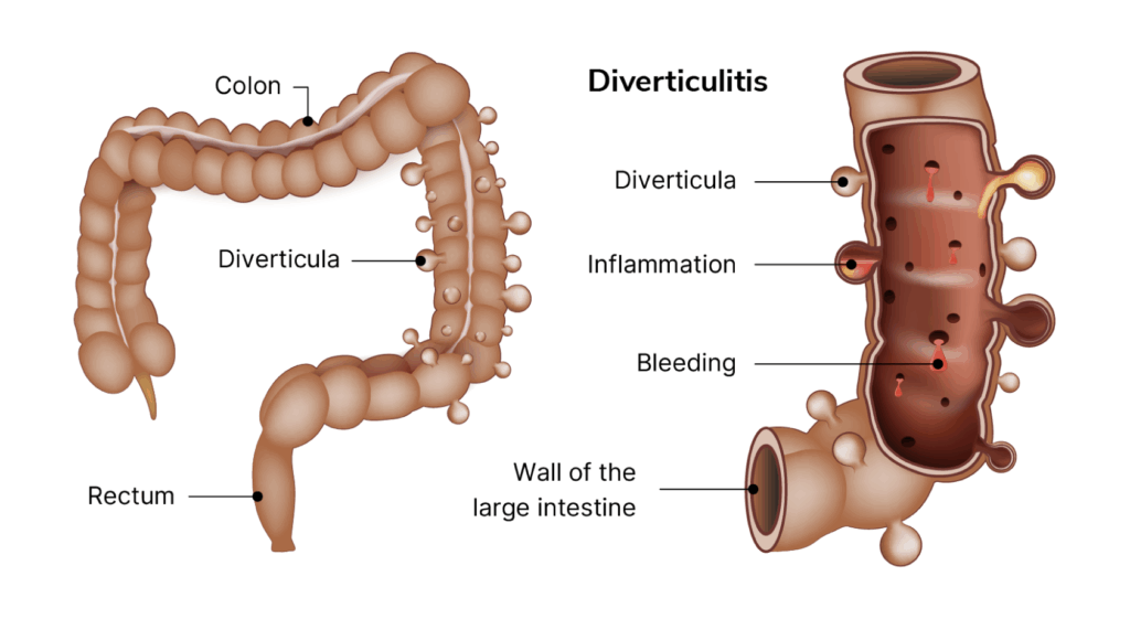 Aelius_Website_Abdominal Pain (Lower Abdomen)-03
