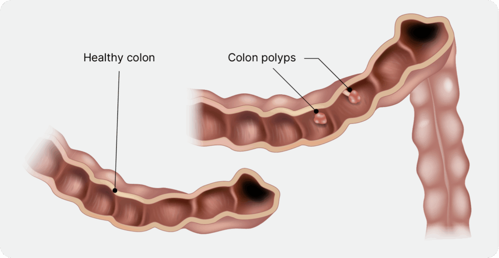 Aelius_Website_Abdominal Pain (Lower Abdomen)-04