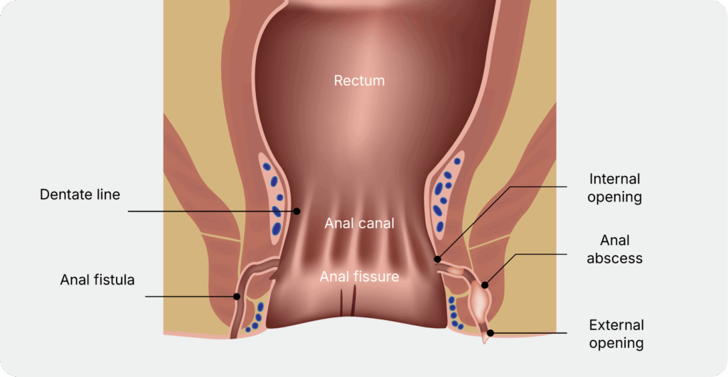 Aelius_Website_Anal Fissure Treatment and Surgery-02