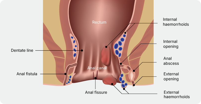Aelius_Website_Anal Pain or Discomfort Page-02